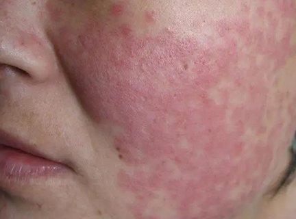 兒童紅斑狼瘡早期有什么癥狀？兒童紅斑狼瘡早期10個征兆