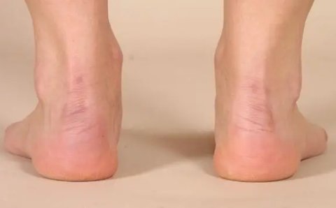 腳后跟疼是怎么回事什么原因？腳后跟痛警惕三種病