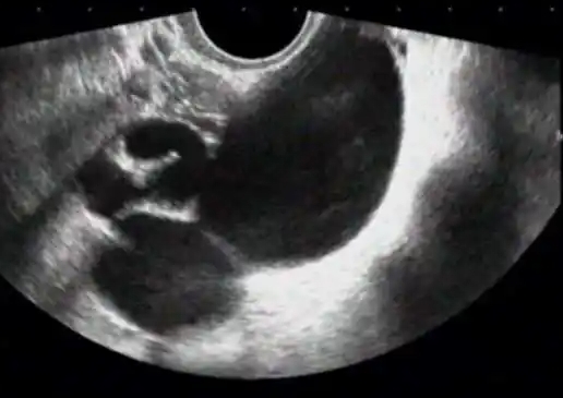 做試管要做多少次陰超？試管嬰兒陰超檢查什么時候做？