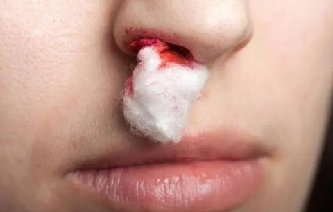 右鼻出血是什么原因引起的？右鼻出血警惕四種原因