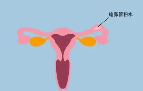 只有一側輸卵管還能正常懷孕嗎？少一根輸卵管的影響