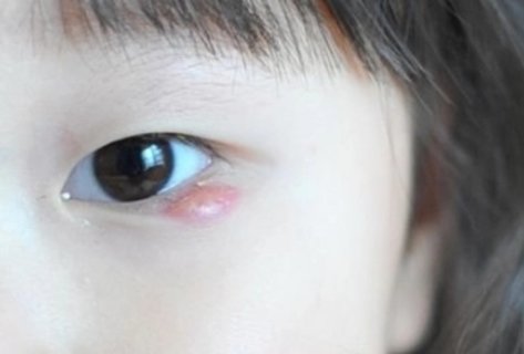 麥粒腫偏方簡(jiǎn)單有效？家庭療法與自然緩解方法