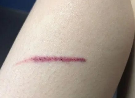 擦傷的傷口怎么樣能快速恢復：家庭護理指南