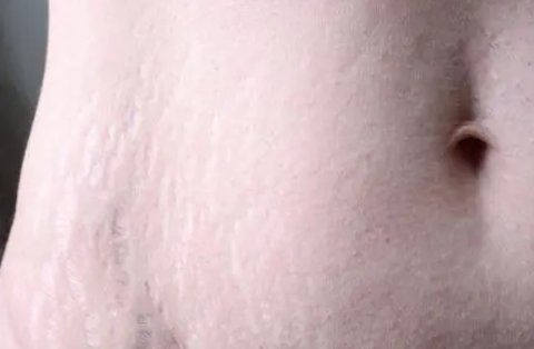 妊娠紋好幾年了怎么淡化去除？多年的妊娠紋去除最好的辦法