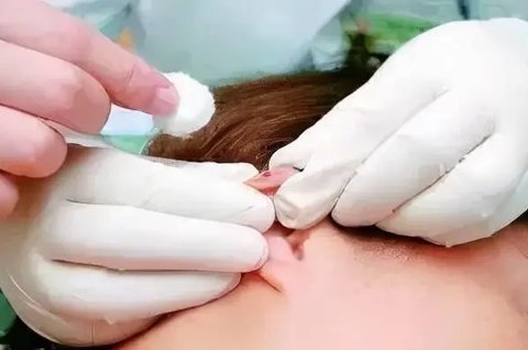 耳尖放血可以治療失眠嗎？耳尖放血的作用與功效