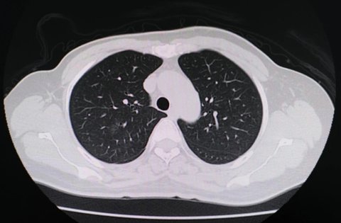 白肺病的癥狀是什么表現？白肺病的癥狀和前兆