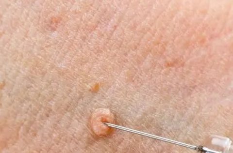 傳染性軟疣會自行消退嗎？傳染性軟疣的自愈方法