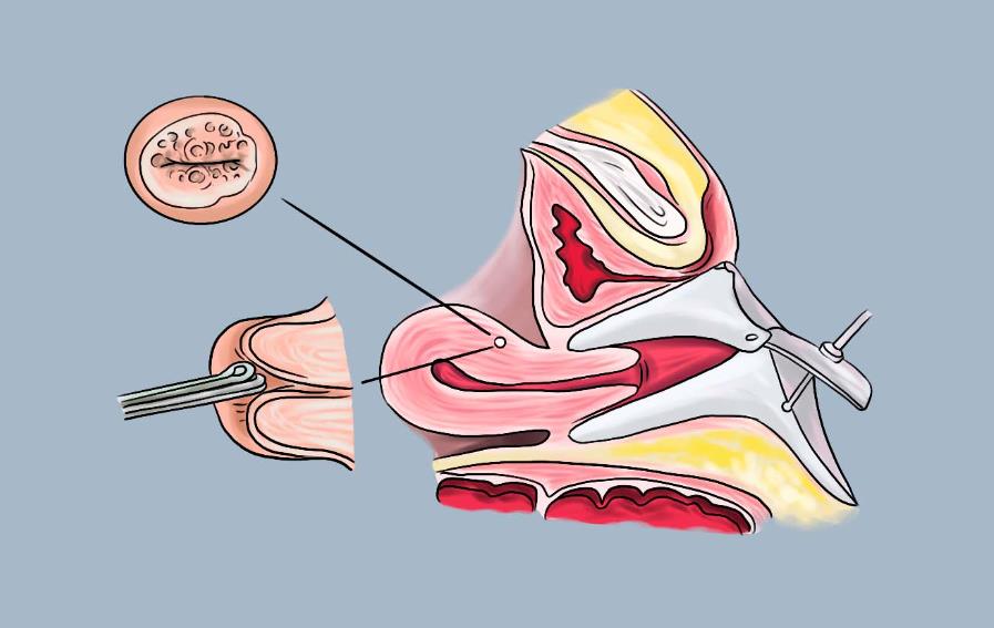 子宮內膜活檢是檢查什么,子宮內膜活檢痛不痛