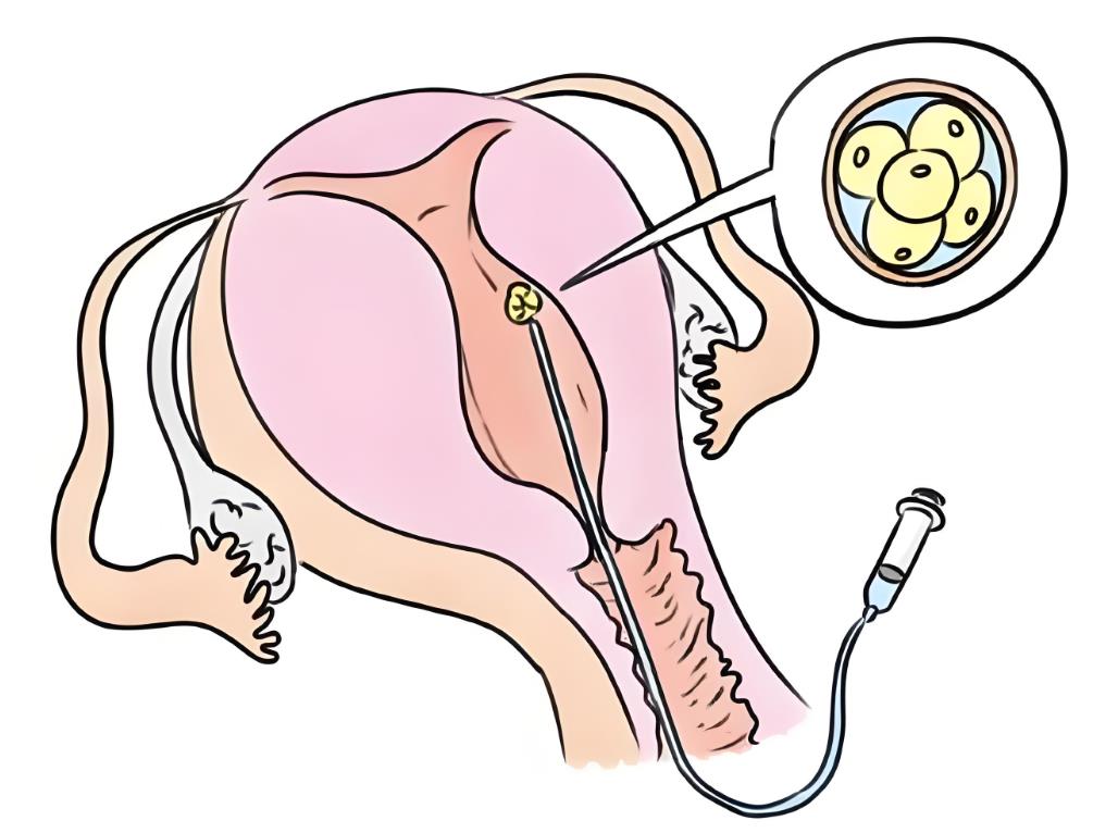 試管移植 試管移植