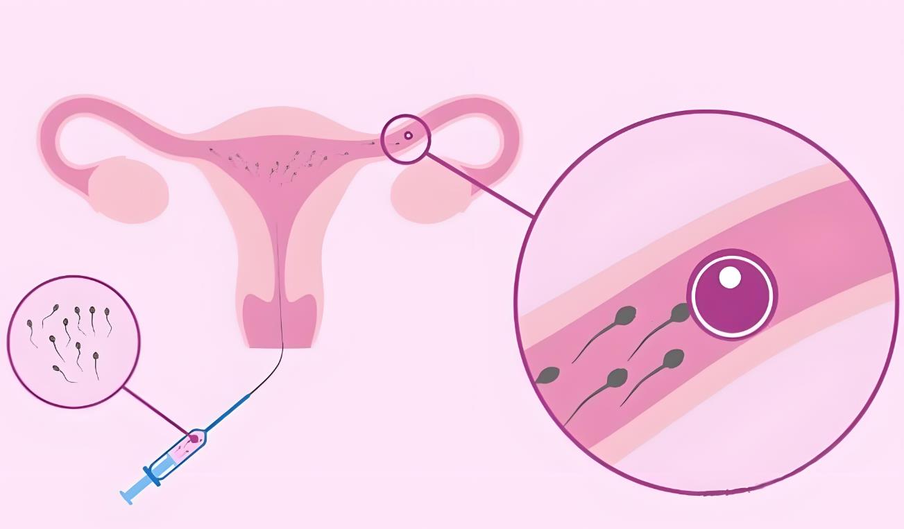 人工授精 人工授精