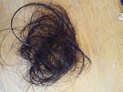 大量掉頭發是多囊卵巢的癥狀之一？多囊卵巢的癥狀