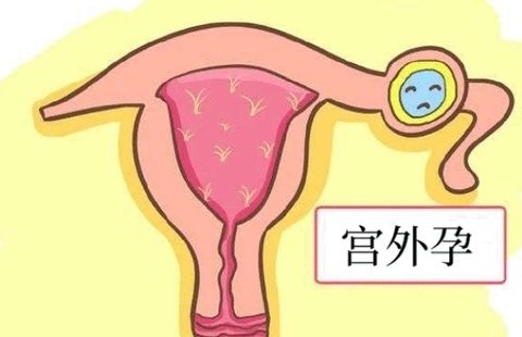 做試管會出現(xiàn)宮外孕嗎？試管嬰兒宮外孕的原因