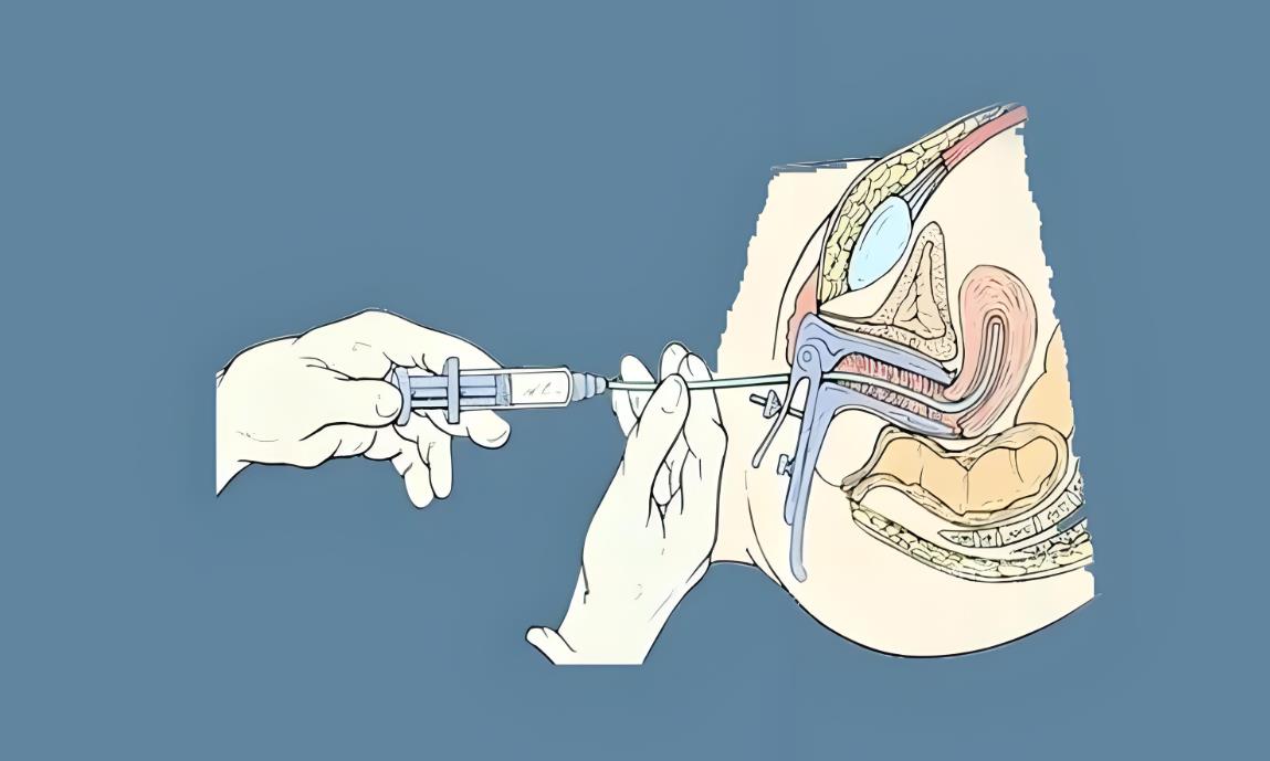 試管促排一般打多少天針取卵