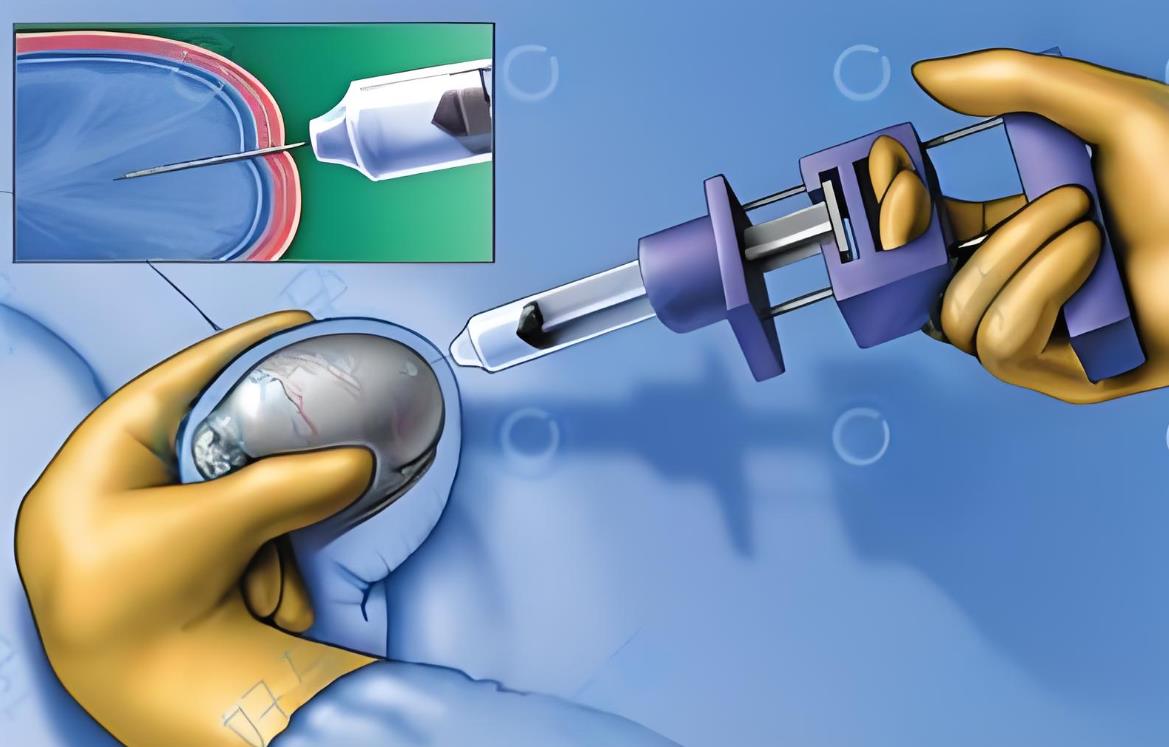 做試管取卵當天要取精嗎多少錢