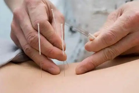 針灸助孕一個月扎幾次？每月治療頻率與效果全解析