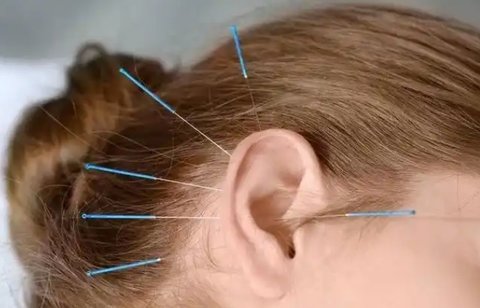 針灸助孕：古老智慧如何開啟現代生育之門