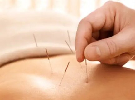 針灸與女性月經：影響機制及調理作用解析