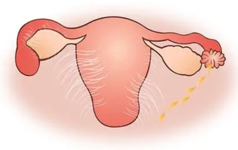 盆腔粘連影響試管嗎？盆腔粘連對試管嬰兒的影響