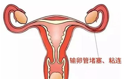 輸卵管粘連對試管有影響嗎？輸卵管粘連與試管嬰兒