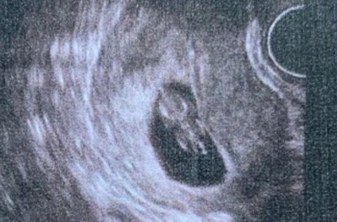 陰超可以檢查出哪些婦科疾病？陰超檢查疾病一覽