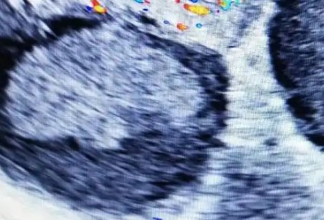 陰超最早幾天查到孕囊？懷孕跡象時間一覽