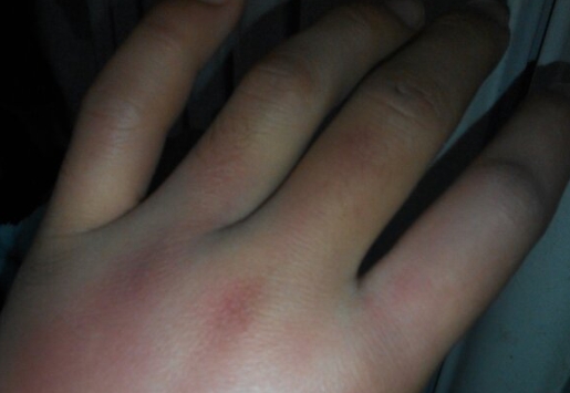 手腫是什么原因引起的？常見原因及應(yīng)對策略