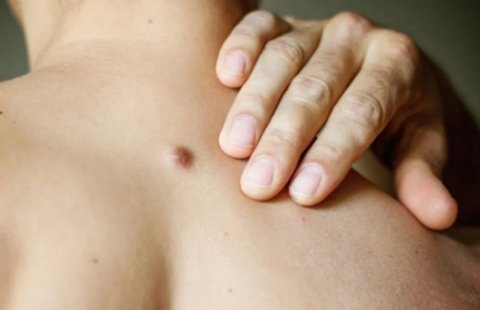 HPV感染是什么樣的？身上5種小疙瘩可能跟HPV感染有關