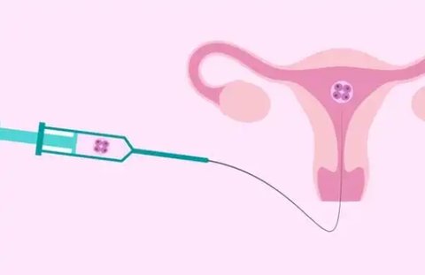 宮腔灌注治療一次需要多少錢？宮腔灌注治療費用解析